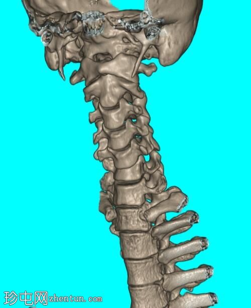 平移旋转损伤-颈椎