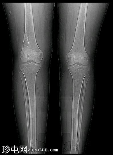 股骨远端非骨化性纤维瘤
