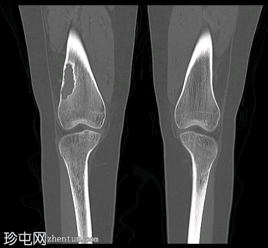 股骨远端非骨化性纤维瘤