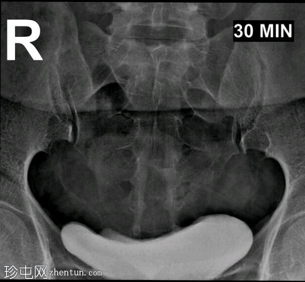 输卵管阻塞，外观类似 IVP