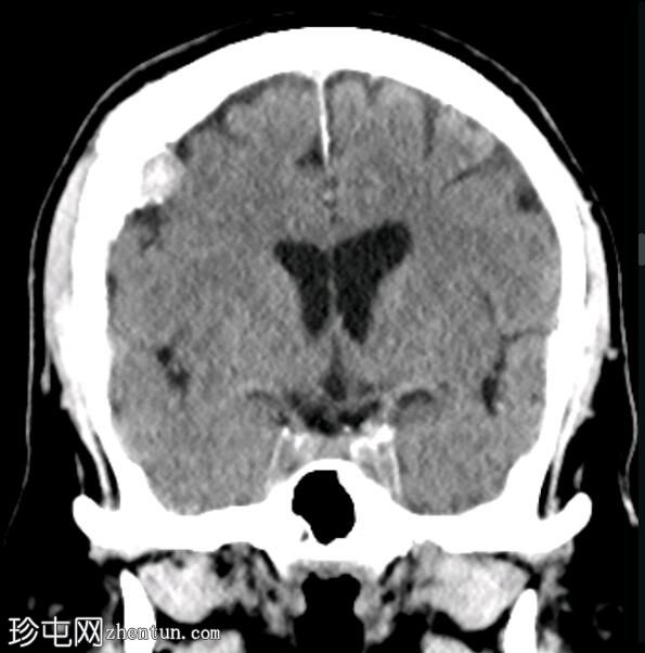 骨内脑膜瘤