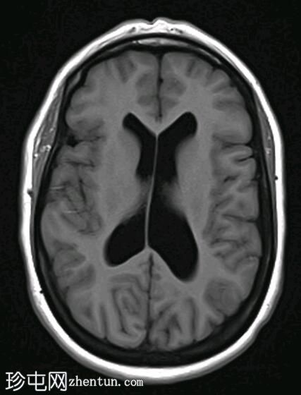 Chiari 1.5 畸形