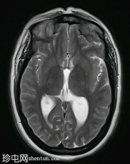 Chiari 1.5 畸形