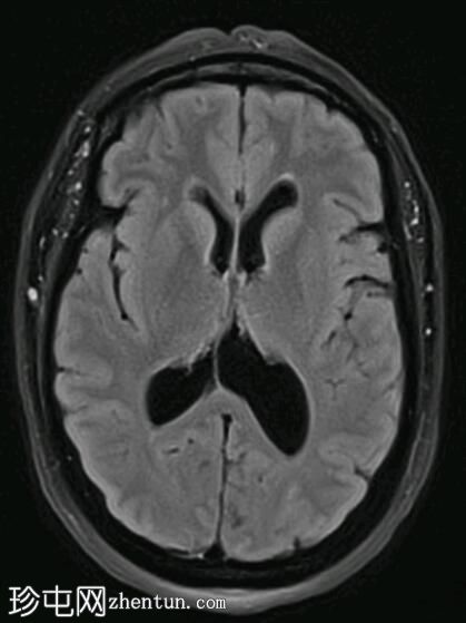 Chiari 1.5 畸形