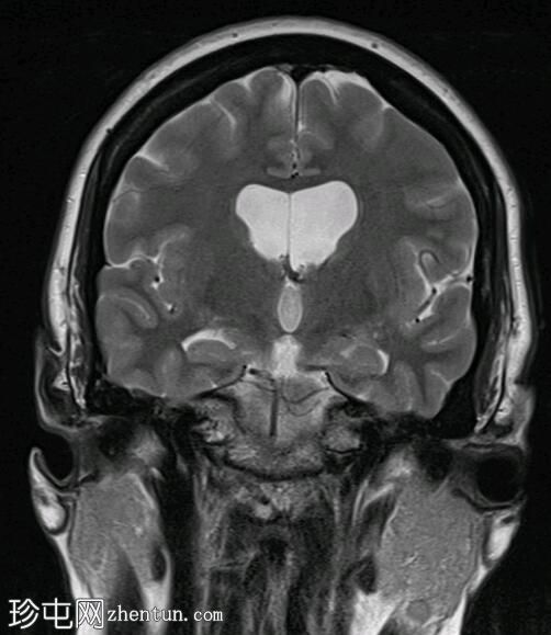 Chiari 1.5 畸形