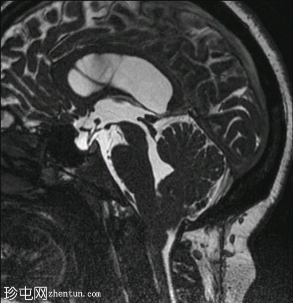 Chiari 1.5 畸形