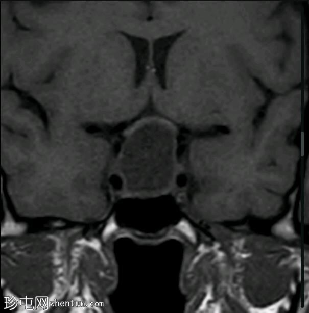 囊性垂体大腺瘤