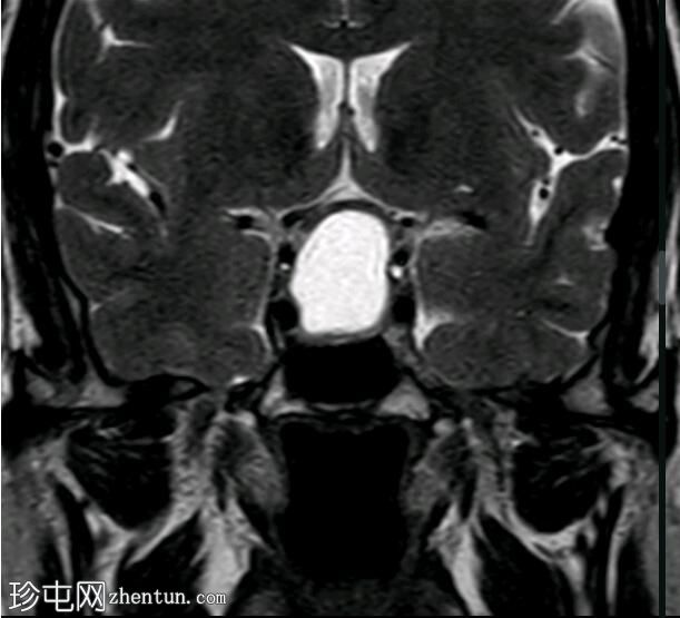 囊性垂体大腺瘤