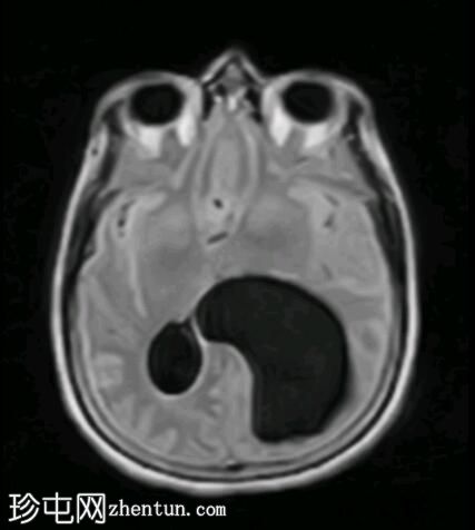 脑室内囊肿