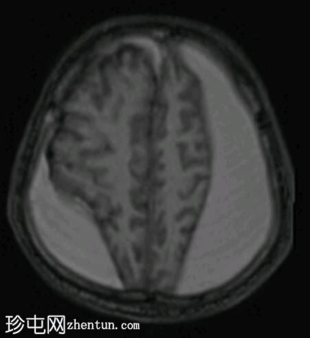 硬膜下出血