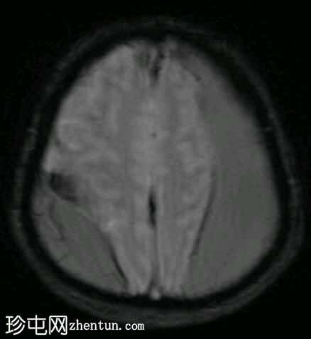 硬膜下出血