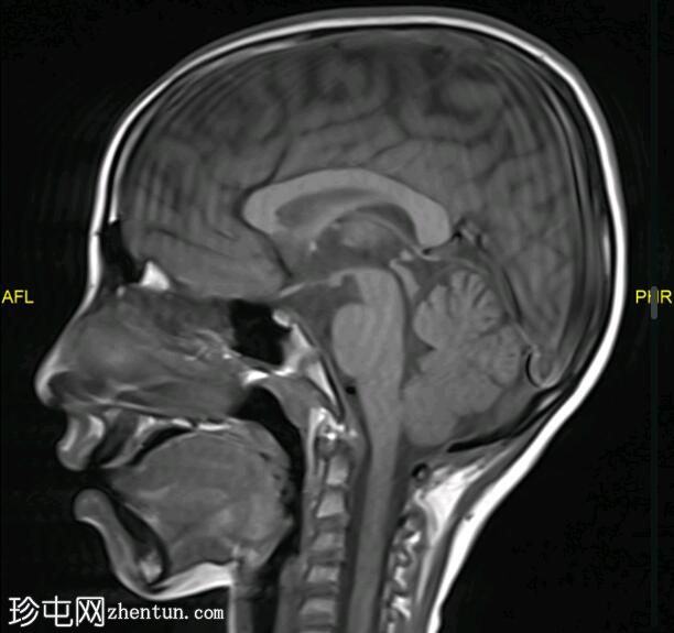 慢性淋巴细胞炎症，伴有对类固醇有反应的脑桥血管周围增强（CLIPPERS）