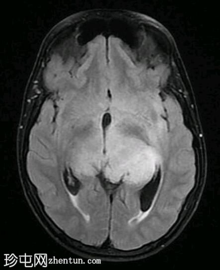双侧丘脑胶质瘤