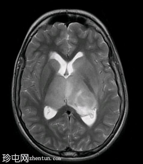 双侧丘脑胶质瘤