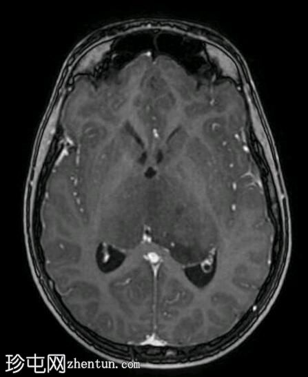 双侧丘脑胶质瘤