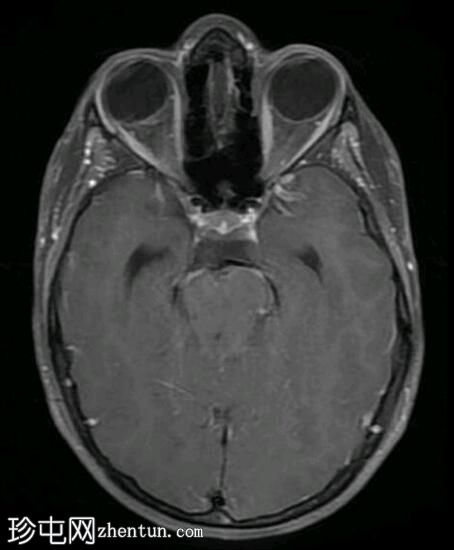 双侧丘脑胶质瘤
