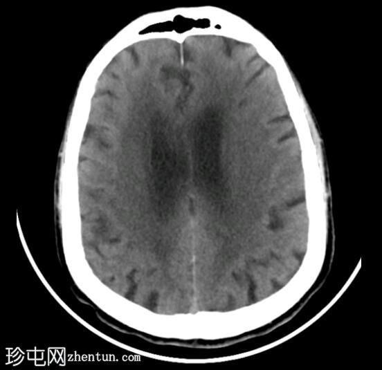 中枢神经系统浅表铁质沉着症