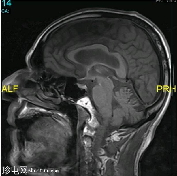 中枢神经系统浅表铁质沉着症