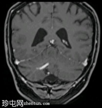 发育性静脉异常