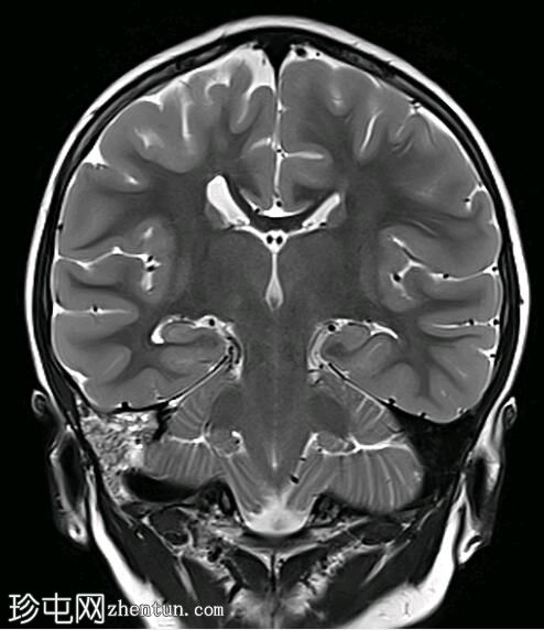胼胝体发育不全伴多小脑回