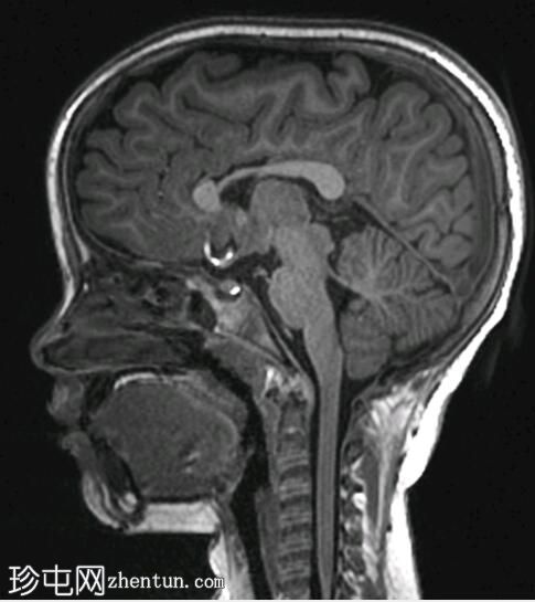 胼胝体发育不全伴多小脑回