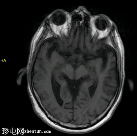 多系统萎缩小脑型（MSA-C）