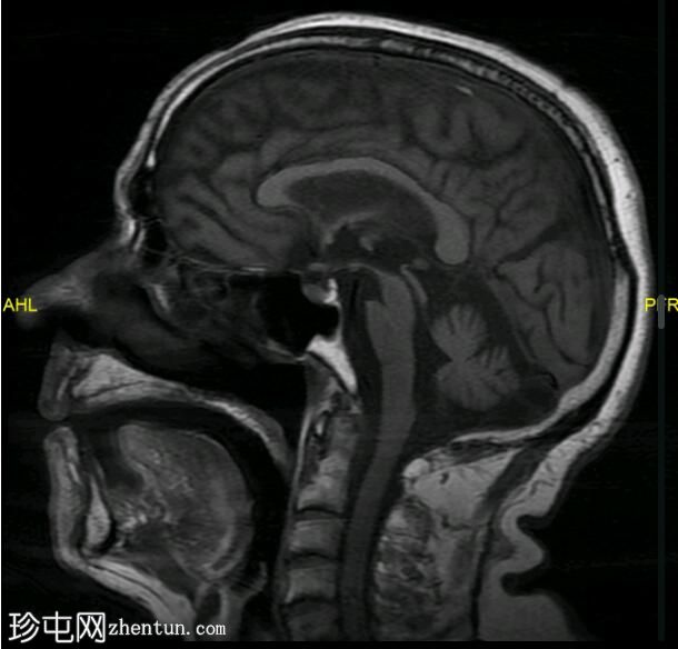 多系统萎缩小脑型（MSA-C）