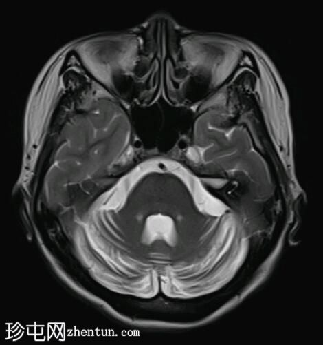 弥漫性小脑萎缩