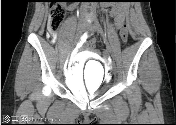 腹膜外膀胱破裂和骨盆骨折