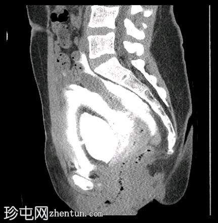 腹膜外膀胱破裂和骨盆骨折