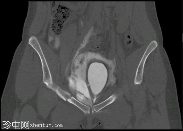 腹膜外膀胱破裂和骨盆骨折