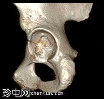 腹膜外膀胱破裂和骨盆骨折