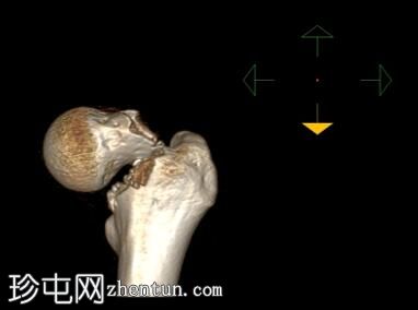 腹膜外膀胱破裂和骨盆骨折