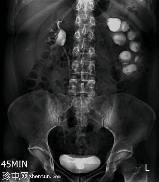 左侧肾盂输尿管连接处梗阻