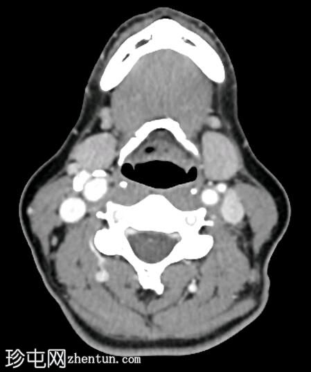 髓样甲状腺癌 (FDG PET-CT)