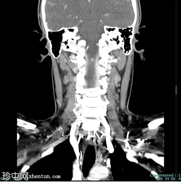 髓样甲状腺癌 (FDG PET-CT)