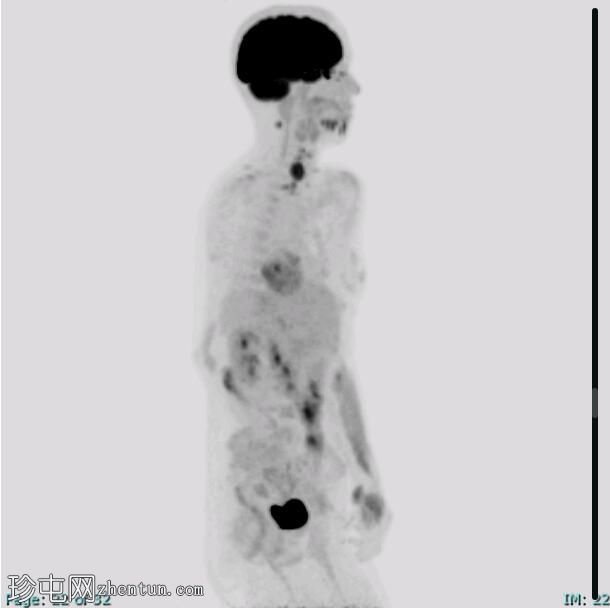 髓样甲状腺癌 (FDG PET-CT)