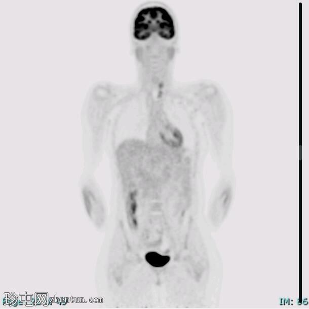 髓样甲状腺癌 (FDG PET-CT)