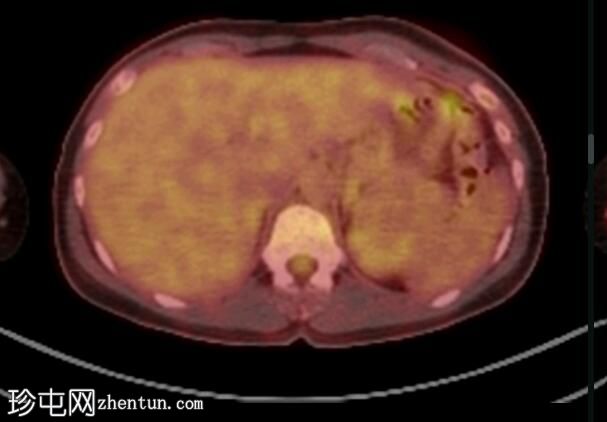 髓样甲状腺癌 (FDG PET-CT)