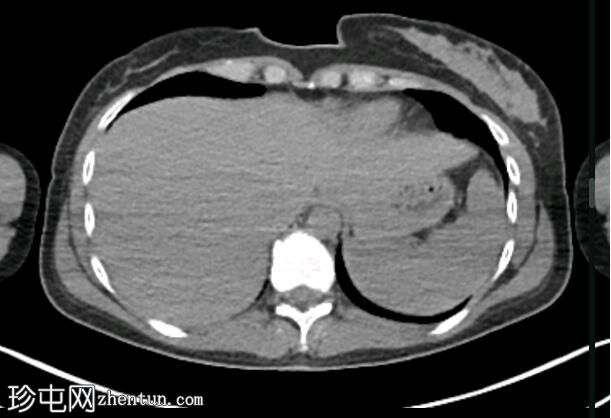 髓样甲状腺癌 (FDG PET-CT)