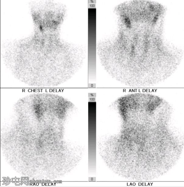 甲状旁腺腺瘤及早期清除（甲氧基异丁基异腈扫描）