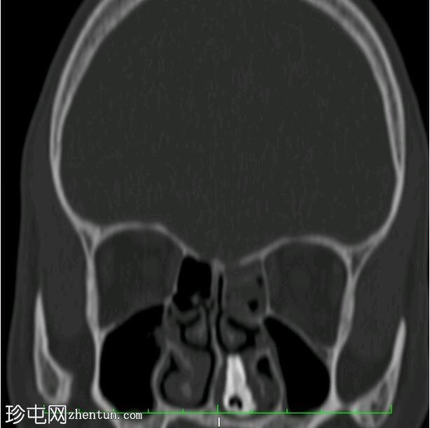 鼻结石