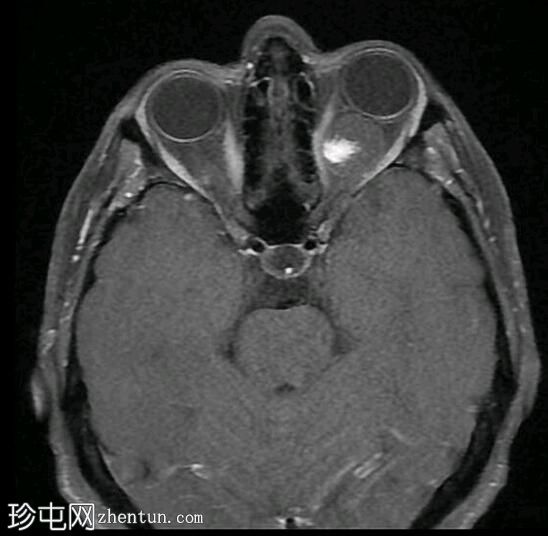 眼眶海绵状血管瘤