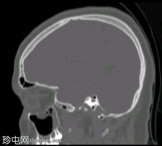 眼眶爆裂性骨折伴有下直肌卡压