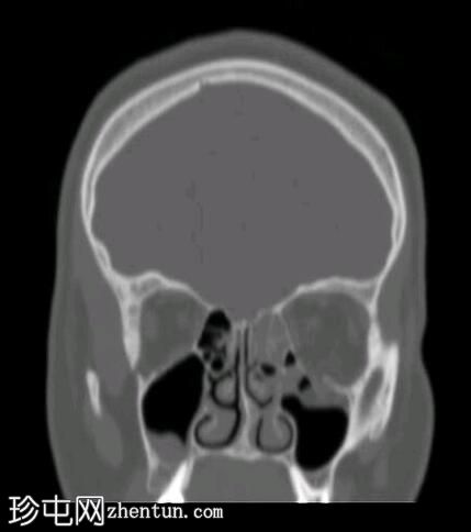 眼眶爆裂性骨折伴有下直肌卡压