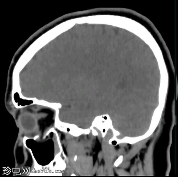 眼眶爆裂性骨折伴有下直肌卡压