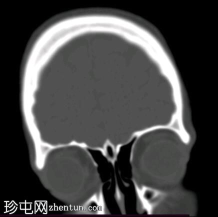 颈鼓室副神经节瘤和乳突炎伴颅内感染