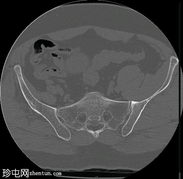 椎体压缩性骨折