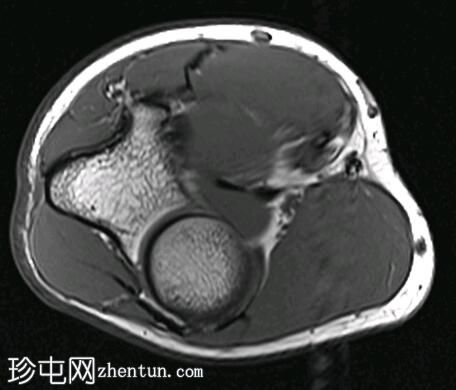 内上髁下骨的肘骨部分撕裂