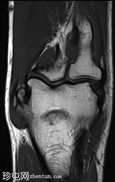 内上髁下骨的肘骨部分撕裂